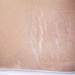 Tak Ingin Stretch Mark Muncul Saat Hamil? Ini 3 Cara Mudah Mencegahnya