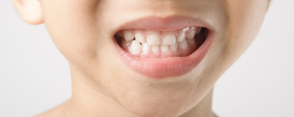 Gigi Anak Tampak Kusam Bernoda dan Sulit Hilang, Apa Penyebabnya?