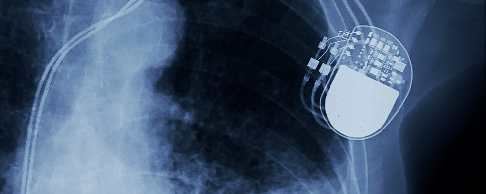 Siapa Saja yang Butuh Tanam Alat Pacu Jantung? Seperti Apa Prosedurnya?