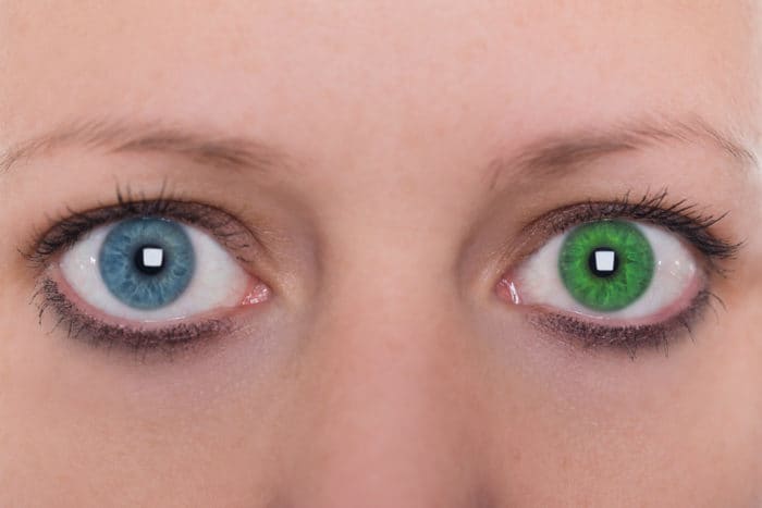 mata beda warna heterochromia