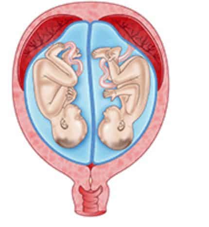 sumber: http://raisingchildren.net.au/articles/twins_fraternal_and_identical.html/context/1641