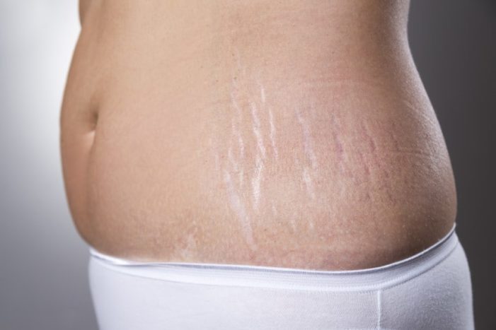 Tips Mencegah Stretch Mark Saat Hamil