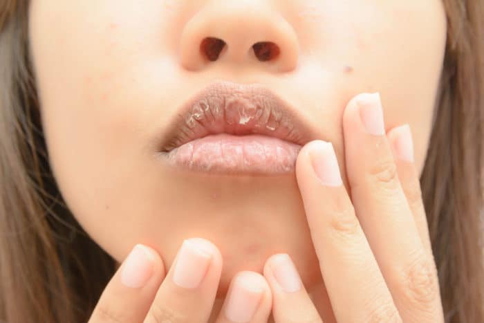 mengatasi bibir kering