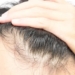Garis Rambut di Sepanjang Dahi Mundur? Hati-hati, Ini Tanda Anda Mulai Botak