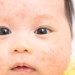Mirip Dengan Cacar Air, Begini Cara Membedakan Gejala Impetigo Pada Anak