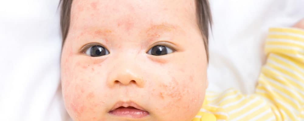 Mirip Dengan Cacar Air, Begini Cara Membedakan Gejala Impetigo Pada