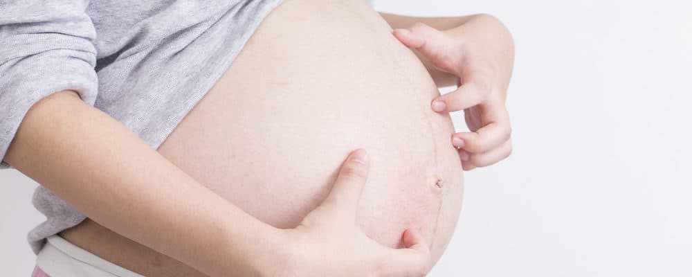 6 Cara Jitu Mengatasi Rasa Gatal Saat Hamil Akibat Penyakit Prurigo