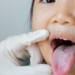 Oral Thrush, Infeksi Jamur di Mulut yang Bisa Menyerang Bayi dan Orang Dewasa
