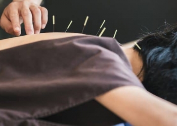 Manfaat Terapi Akupunktur untuk Atasi Insomnia