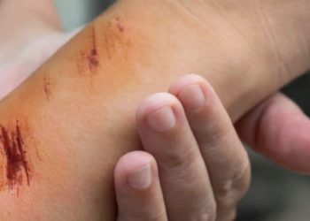 Jenis-jenis Luka dan Penanganan Pertama yang Sesuai