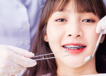 Kapan Sebaiknya Memasang Behel agar Tetap Aman dan Efektif?