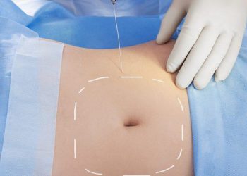 Mengenal Seluk Beluk Laser Lipolysis untuk Menyingkirkan Lemak