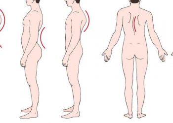 Mengenal Berbagai Kelainan Tulang Belakang: Skoliosis, Kifosis, dan Lordosis