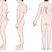 Mengenal Berbagai Kelainan Tulang Belakang: Skoliosis, Kifosis, dan Lordosis