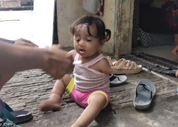 Balita di Tangsel Idap Penyakit Multiple Congenital Anomalies Butuh Bantuan