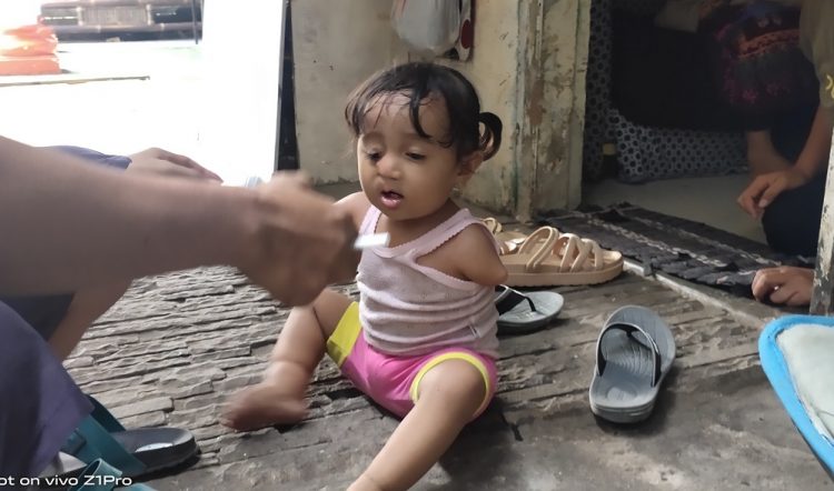 Balita pengidap penyakit Multiple Congenital Anomalies di Tangsel. (SNG)