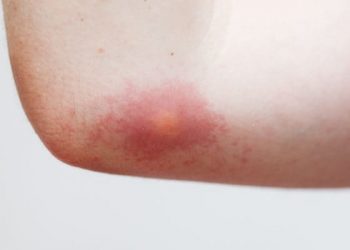 Pertolongan Pertama Disengat Lebah atau Tawon