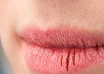 10 Cara Ampuh Mengatasi Masalah Mulut Kering