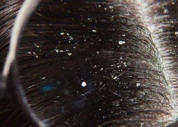 Trik Jitu Mengatasi Ketombe