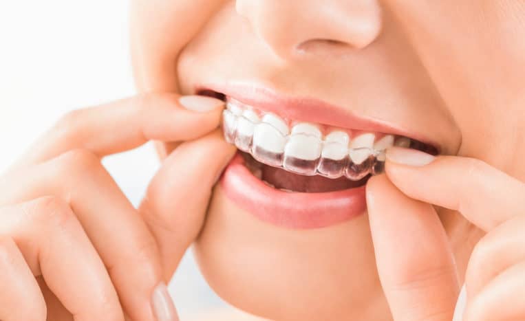 invisalign adalah cara merapikan gigi