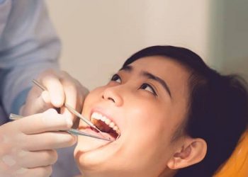 Beragam Cara Paling Jitu untuk Menghilangkan Karang Gigi