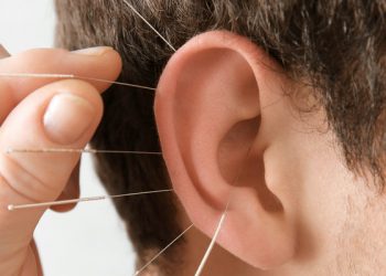 Melangsingkan Tubuh Dengan Akupunktur, Efektifkah?