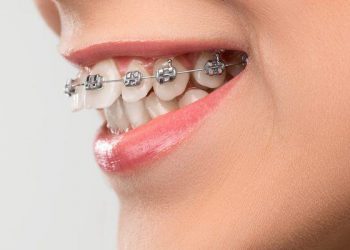 Gigi Tonggos, Penyebab dan Cara Memperbaikinya