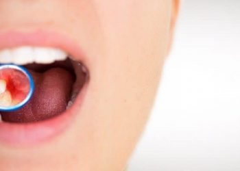 Rekomendasi Obat Radang Gusi yang Ampuh, di Rumah dan di Apotek