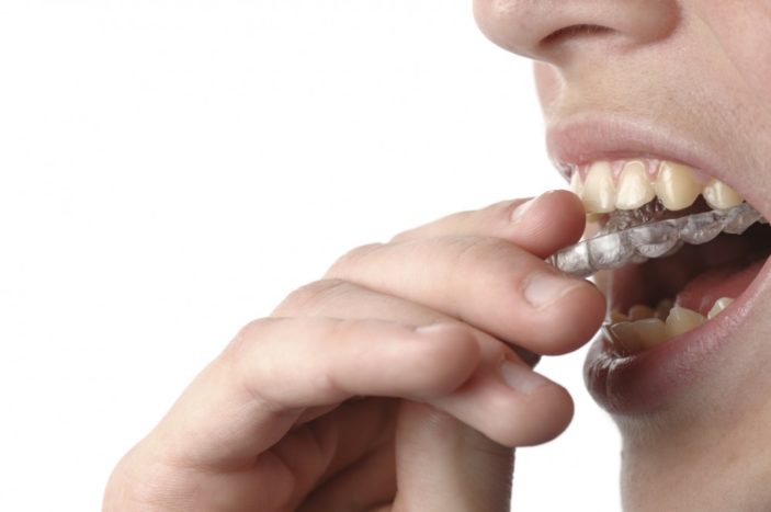 jenis retainer transparan