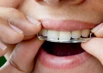 Apa itu Retainer Gigi?