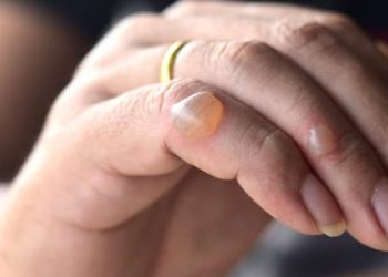 Kulit Melepuh, Bagaimana Cara Mengobatinya?