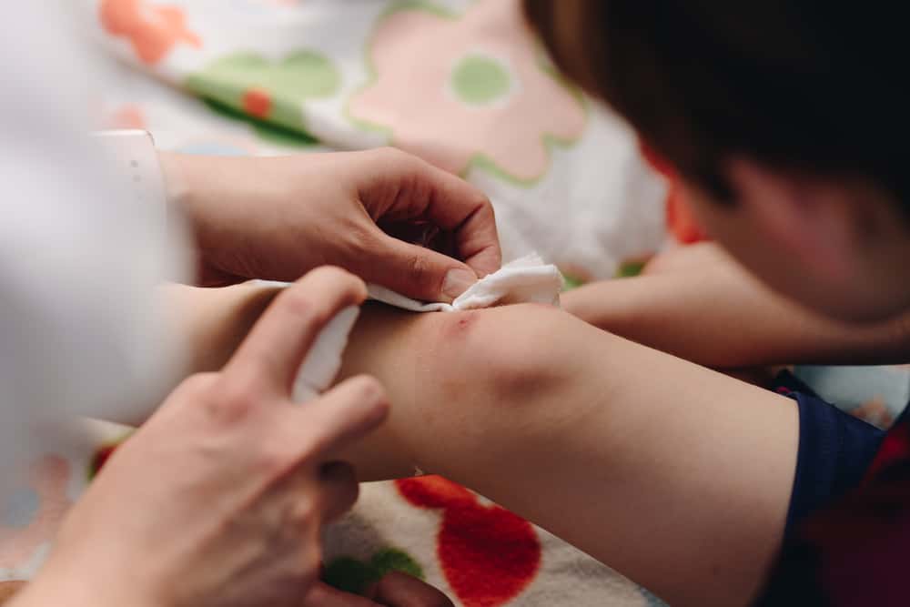 cara mengobati luka pada anak