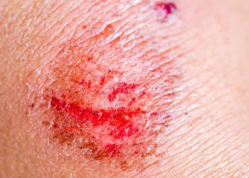 Luka Lecet, Pengertian, Penyebab, Pertolongan Pertama, dan Perawatan