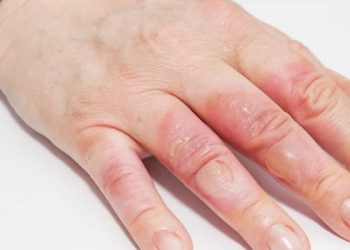 Mendeteksi Derajat Luka Bakar Plus Cara Perawatannya