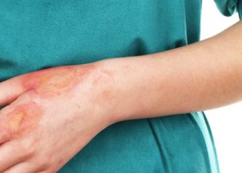 5 Bahan Alami Ini Bisa Membantu Menghilangkan Bekas Luka Bakar