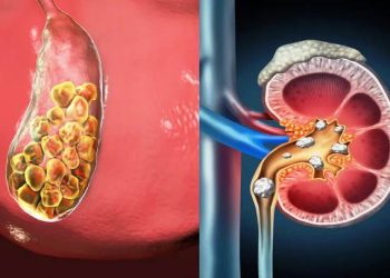 Kiat Berpuasa Aman bagi Penderita Batu Ginjal