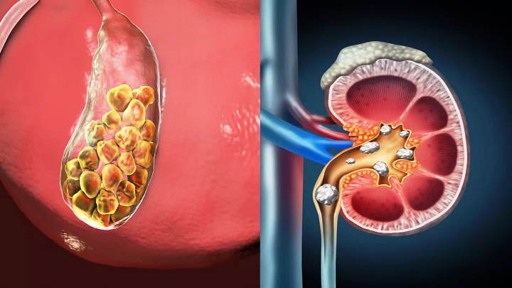 Ilustrasi batu ginjal. (NET)