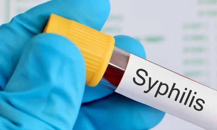 Ilustrasi sifilis. (NET)