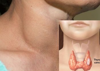 Timbul Benjolan di Leher Jangan Panik, Begini Cara Pemeriksaan dan Penanganannya!