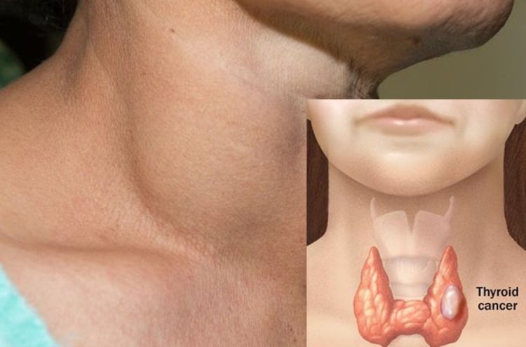 Ilustrasi Tiroid. (NET)