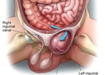Kenali Penyebab dan Penanganan Hernia Inguinal pada Anak Laki-laki