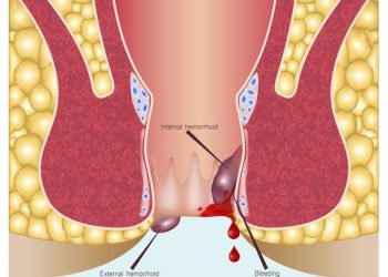 Bethsaida Hospital Serang Siapkan Layanan Operasi Wasir Tanpa Bekas