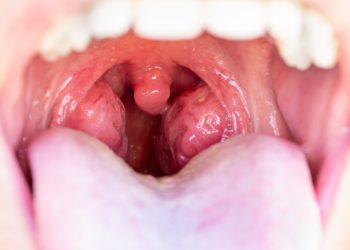 Teknologi Mutakhir untuk Atasi Radang Amandel di Bethsaida Hospital