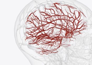 Bethsaida Hospital Punya Teknologi DSA untuk Deteksi Dini Stroke